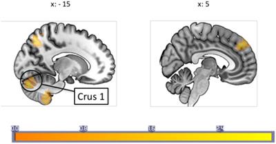 Responsivity of Periaqueductal Gray Connectivity Is Related to Headache Frequency in Episodic Migraine